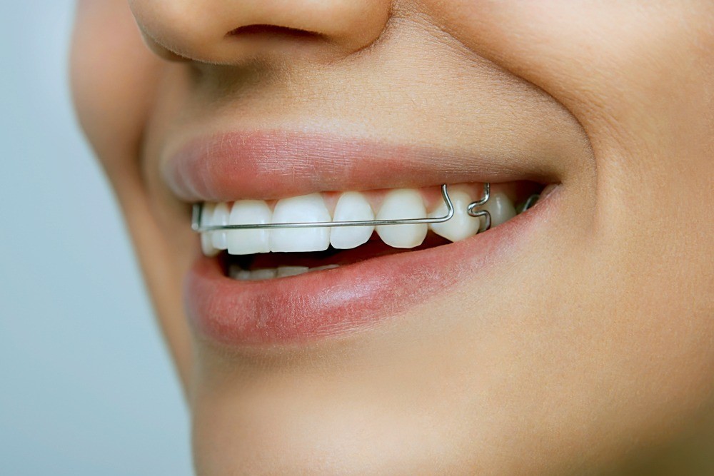 Best Affordable North Las Vegas Orthodontic Retainers